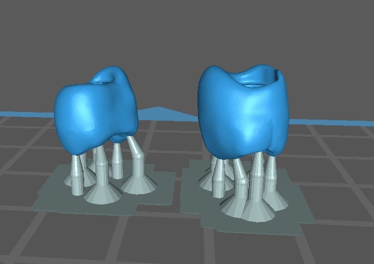 La Revolución Digital en la Odontología: El Proceso de Impresión 3D de prótesis en Master Dent