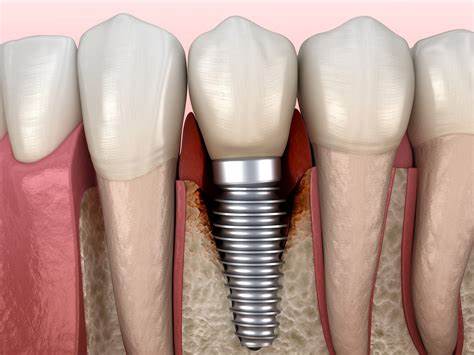 Como limpiar tu Implante Dental